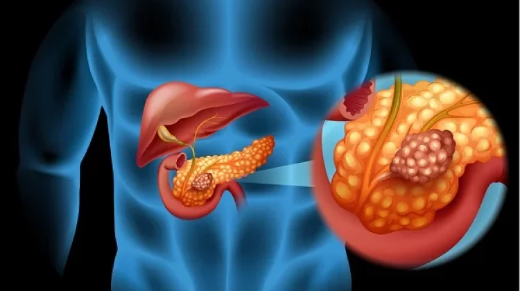 Mengenal Tumor Pankreas: Gejala, Penyebab, dan Cara Pencegahannya