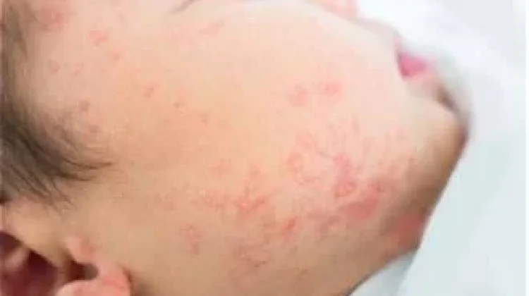 Alergi Susu Sapi: Kenali Penyebab, Gejala, Cara Diagnosis, dan Pengobatannya