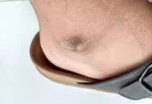 Cara Menghilangkan Bercak Hitam di Kaki