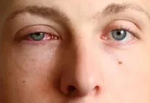 Penyebab Mata Gatal dan Merah