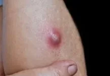 Cara Alami  Mengobati Penyakit Bisul