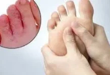 Enam Penyebab Gatal di Sela Jari-Jari Kaki