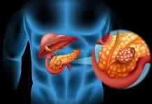 Mengenal Tumor Pankreas: Gejala, Penyebab, dan Cara Pencegahannya