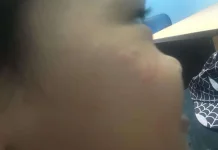 Anak Biduran, Cara Aman dan Efektif Meredakannya di Rumah