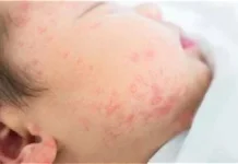 Alergi Susu Sapi: Kenali Penyebab, Gejala, Cara Diagnosis, dan Pengobatannya
