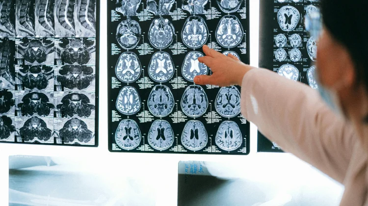 Neuroplastisitas dan Cara Otak Beradaptasi