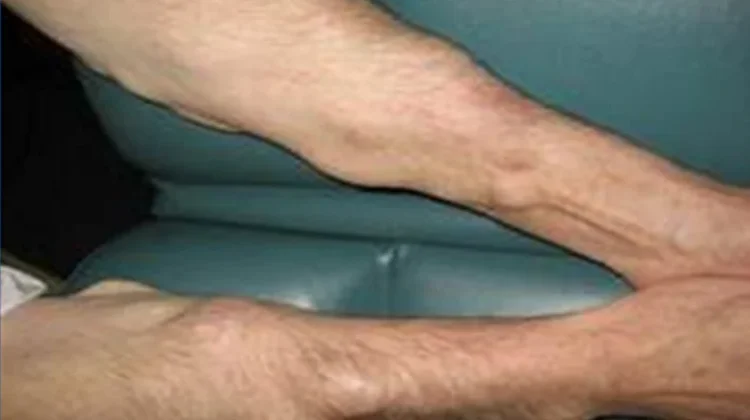 Mengenal Penyakit Lipoma dan Cara Mengatasinya