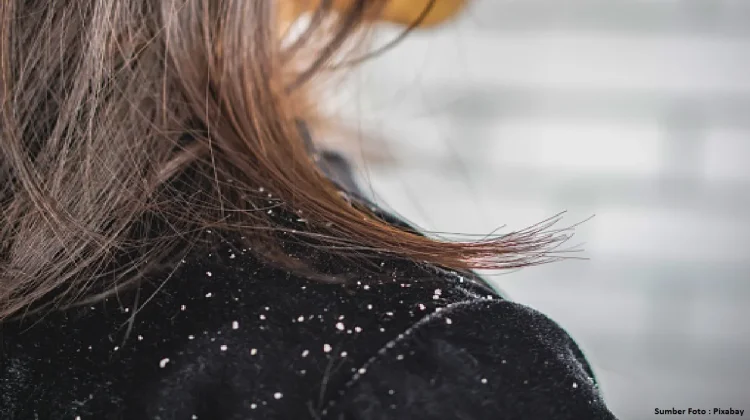 Mengenal Penyebab dan Cara Mengatasi Rambut Berketombe