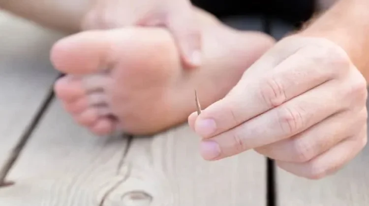 Begini Cara Mengatasi Kaki yang Terkena Tusukan Paku Berkarat