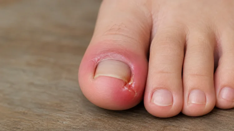 Cara Mengatasi Cantengan Jempol Kaki