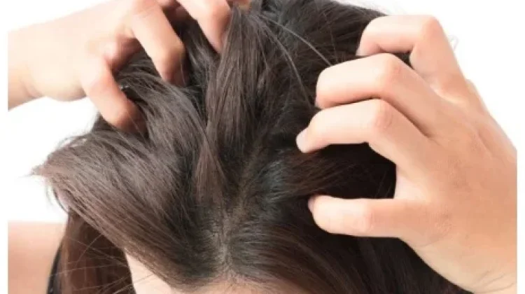 Rambut Gatal dan Berketombe? Kenali Cara Merawat Kulit Kepala