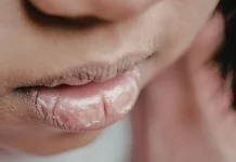 Bibir Pecah-Pecah, Tanda Masalah Kesehatan?