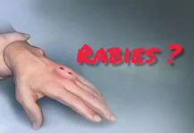 Kasus Gigitan Hewan Penular Rabies di Kaur Tinggi