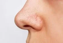 Apakah Memencet Komedo Picu Pori Pori Membesar?