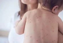Anak-Anak Rentan Terserang Penyakit Cacar Air