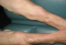 Mengenal Penyakit Lipoma dan Cara Mengatasinya