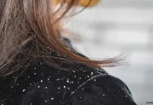 Mengenal Penyebab dan Cara Mengatasi Rambut Berketombe