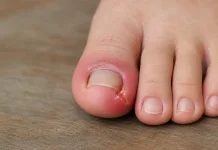 Cara Mengatasi Cantengan Jempol Kaki