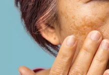 Apa Itu Melasma? Kenali Penyebab dan Dampaknya pada Kulit