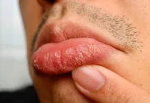 Bibir Pecah-Pecah Bisa Jadi Tanda Kondisi Tertentu, Ini Penjelasannya