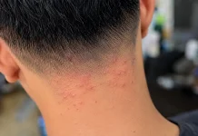Penyebab Kepala Gatal dan Bentol setelah Potong Rambut