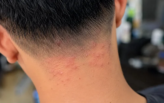 Penyebab Kepala Gatal dan Bentol setelah Potong Rambut