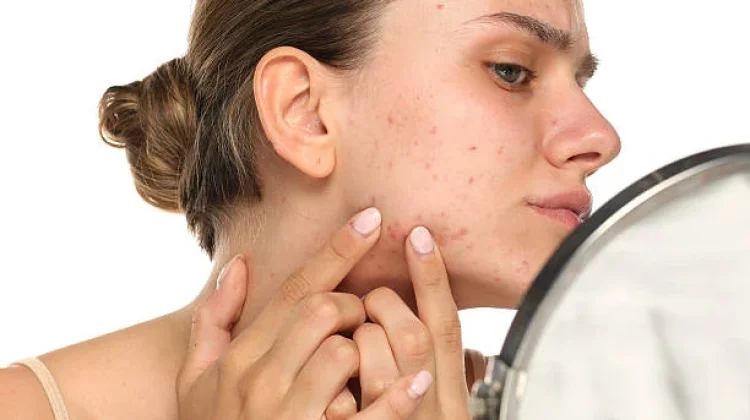 Sering Breakout Padahal Sudah Skincare? Cek Kebiasaan yang Perlu Dihindari