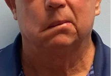 Bell's Palsy Bisa Sembuh Total, Ini yang Membedakannya dari Stroke