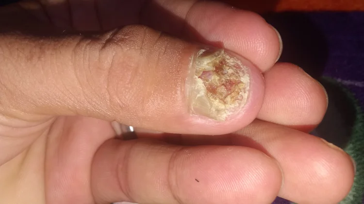 Mengulik Penyebab Kuku Cantengan