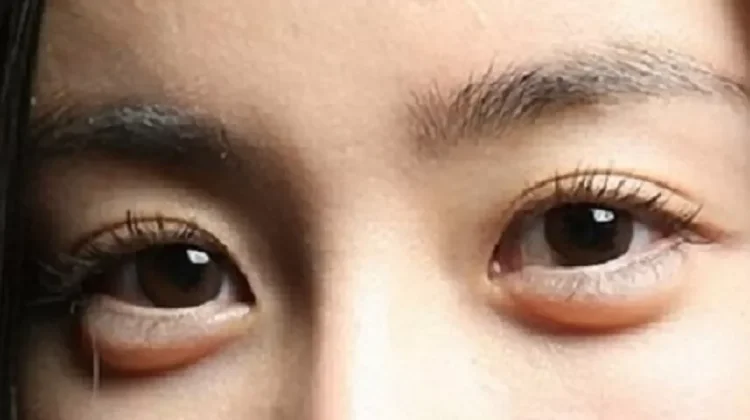 Bye Kantung Mata! Ini Cara Simpel Biar Wajah Segar Lagi