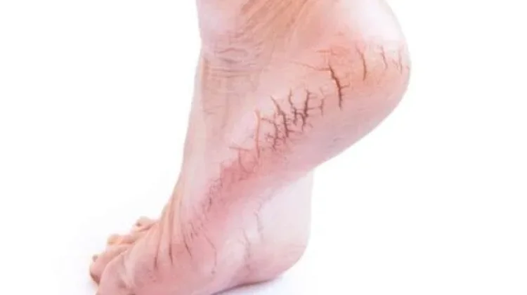 Bye Kaki Pecah-Pecah! Cara Simpel Bikin Tumit Halus Lagi