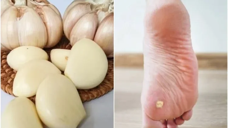 Bawang Putih Bisa Atasi Mata Ikan, Mitos atau Alternatif Alami?