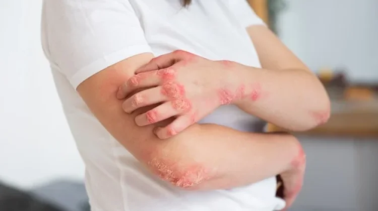 Peran Psikodermatologi dalam Menjelaskan Hubungan Emosi dan Penyakit Eksim