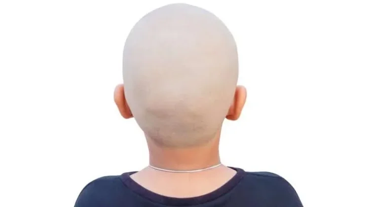 Anak Kepala Botak Gampang Masuk Angin?