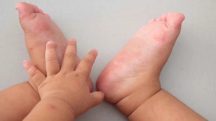 Flu Singapura pada Anak, Yuk Kenali Gejalanya!