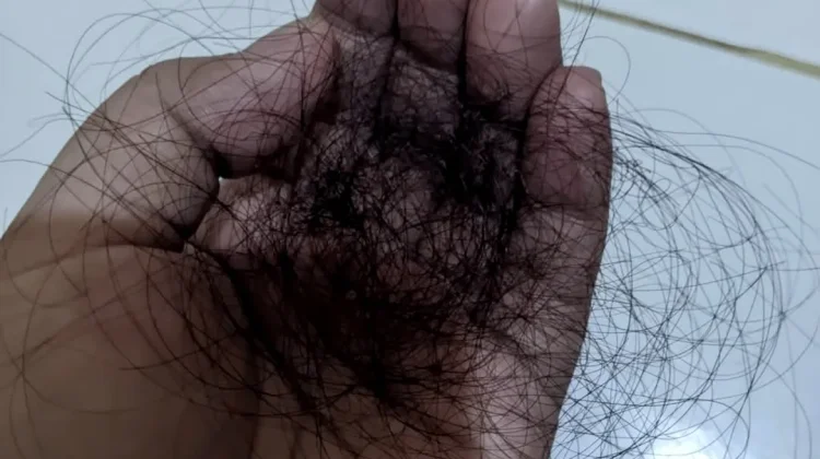 Inilah Cara Alami Mengatasi Rambut Rontok akibat Kurang Nutrisi
