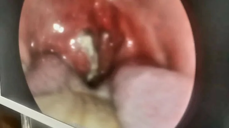 Tips Sehat Meredakan Radang Tenggorokan
