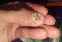 Mengulik Penyebab Kuku Cantengan