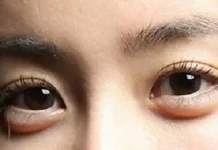 Bye Kantung Mata! Ini Cara Simpel Biar Wajah Segar Lagi