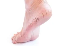Bye Kaki Pecah-Pecah! Cara Simpel Bikin Tumit Halus Lagi