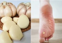 Bawang Putih Bisa Atasi Mata Ikan, Mitos atau Alternatif Alami?