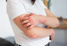 Peran Psikodermatologi dalam Menjelaskan Hubungan Emosi dan Penyakit Eksim