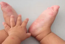 Flu Singapura pada Anak, Yuk Kenali Gejalanya!