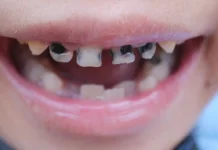 Kenali Jenis Makanan yang Merusak Gigi Anak