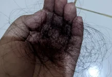 Inilah Cara Alami Mengatasi Rambut Rontok akibat Kurang Nutrisi