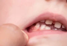 Cara Efektif Atasi Gusi Berdarah pada Anak