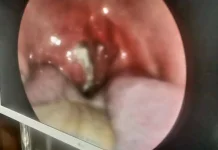 Tips Sehat Meredakan Radang Tenggorokan