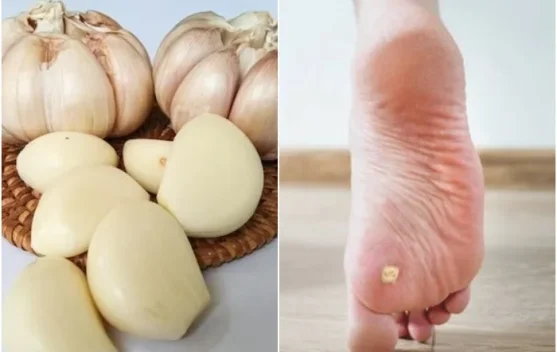 Bawang Putih Bisa Atasi Mata Ikan, Mitos atau Alternatif Alami?