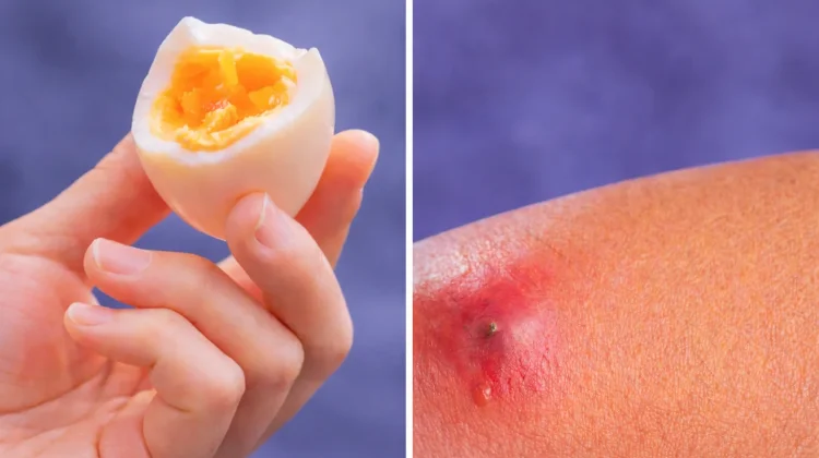 Mitos atau Fakta: Makan Telur Bisa Bikin Bisulan?