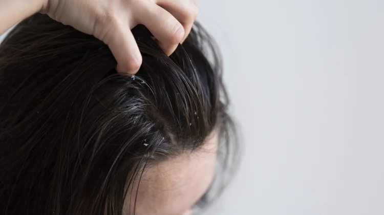 Rambut Cepat Lepek? Kenali Penyebab dan Cara Mengatasinya